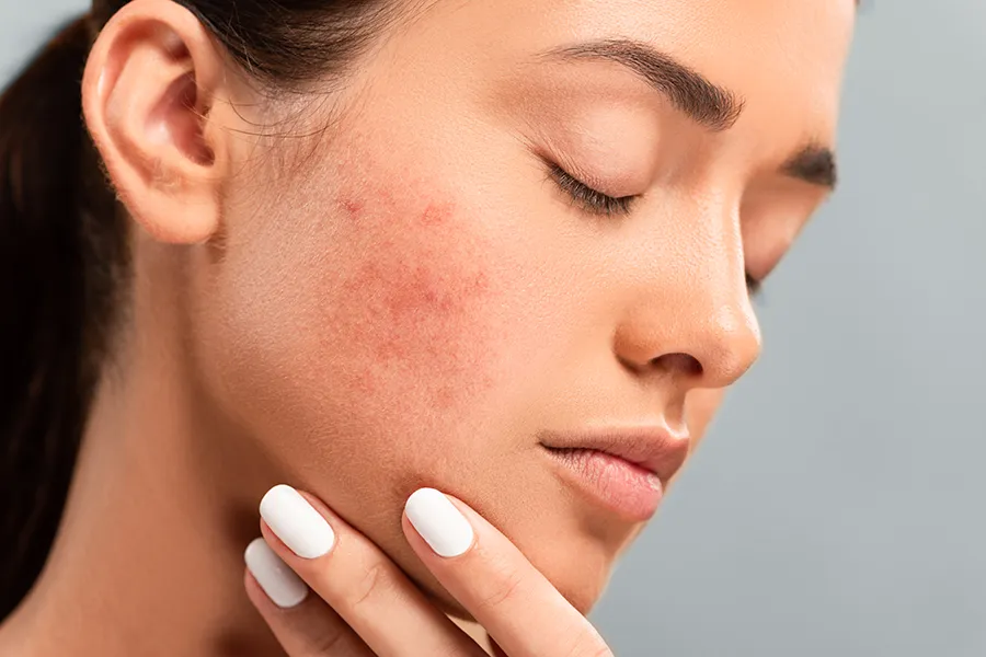 Acne-Clinic Side profile of a woman touching her irritated cheek with visible acne, representing the personalized acne solutions available by Brandi Terra, NP at Oak & Stone Wellness in East San Diego.