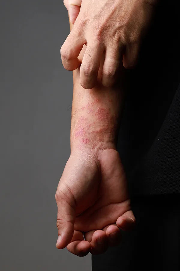 Eczema-Treatment One hand scratches an area irritated by eczema on the other wrist. Get treatment for eczema from Brandi Terra, NP at Oak & Stone Wellness in East San Diego.