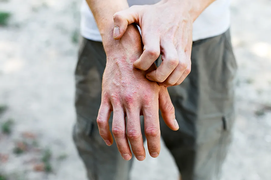 Psoriasis-Clinic Close-up of a man scratching his hands while experiencing Psoriasis. Get care for Psoriasis from Brandi Terra, NP at Oak & Stone Wellness in East San Diego.