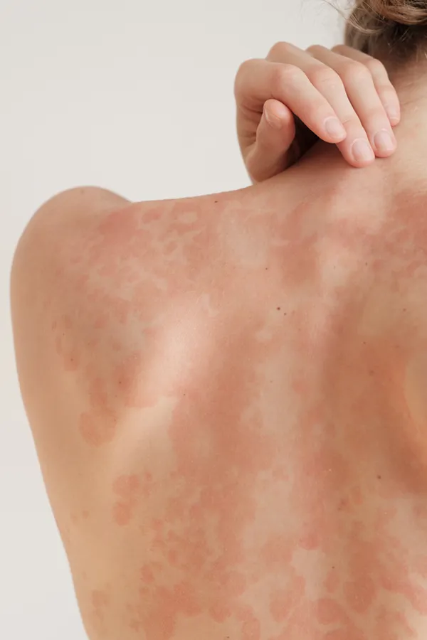 Psoriasis-Treatment The back and shoulder of a woman experiencing Psoriasis. Get treatment for Psoriasis from Brandi Terra, NP at Oak & Stone Wellness in East San Diego.